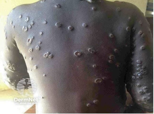 mpox itled